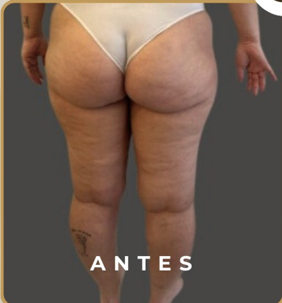 Resultado Desinflama Lipedema